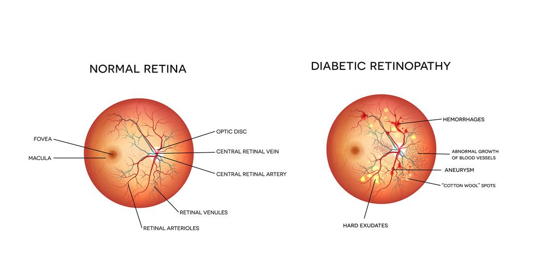 Diabetic Retinopathy